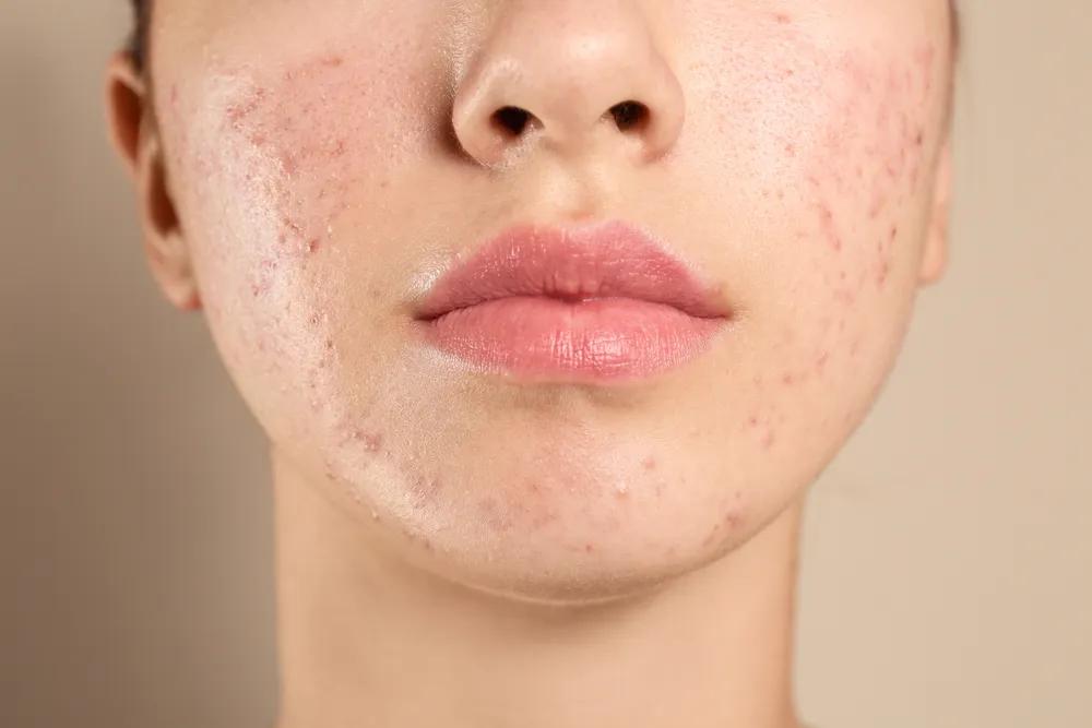 why acne keep coming back