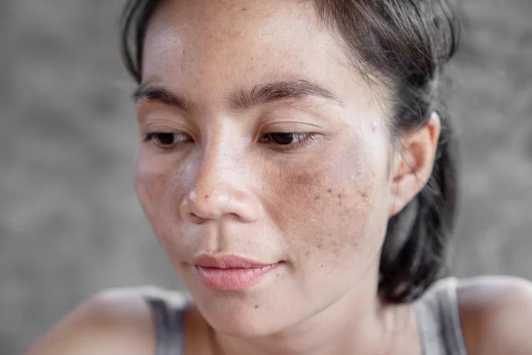 Melasma in Asian skin and how to treat