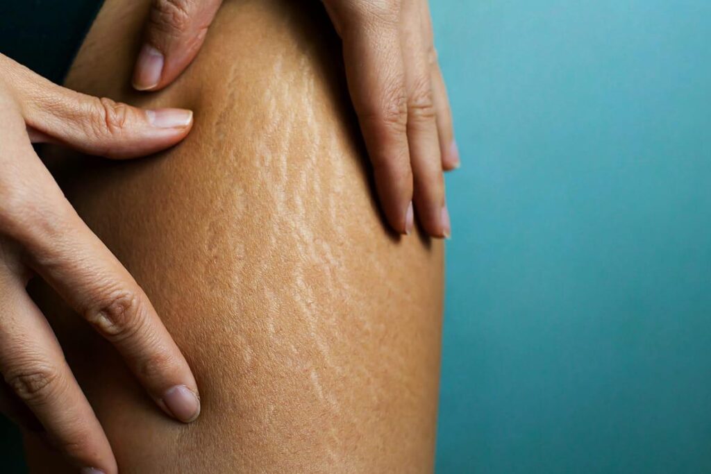 Mature white stretch marks (striae alba) on the inner thigh. These marks are fully healed and appear silver or pearly white.