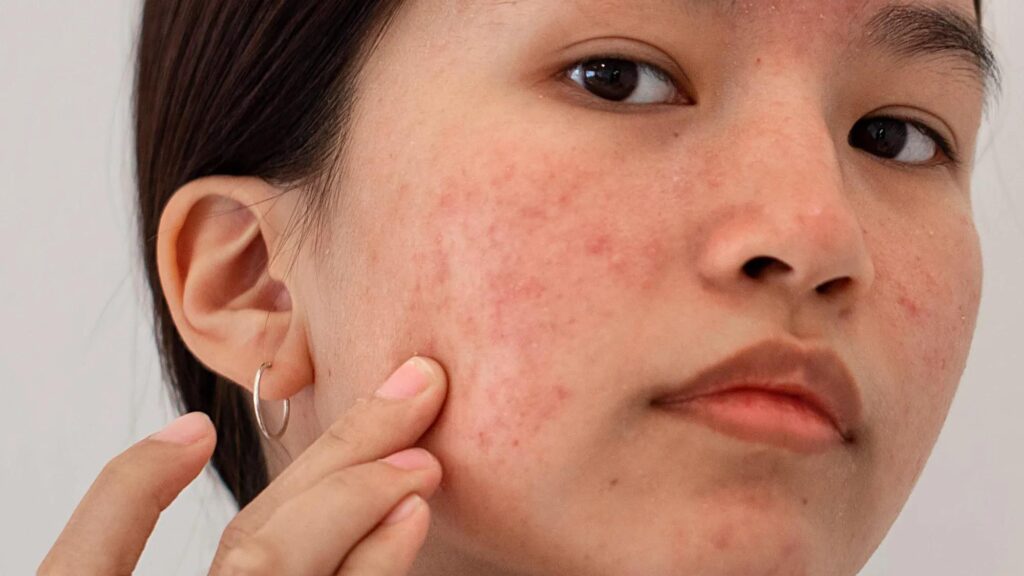 acne scar treatment penang